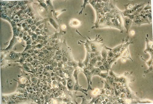 Detroit 562 人咽头癌胸水转移细胞