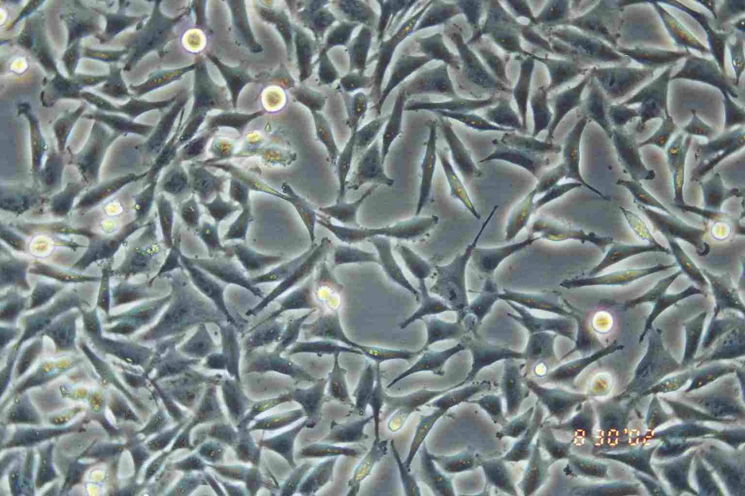 A2058 人无黑素性黑色素瘤（淋巴转移）