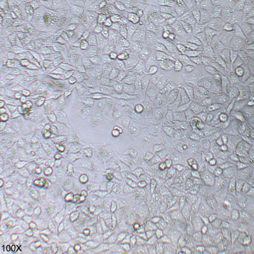 AN3 CA 人子宫内膜腺癌(转移)细胞