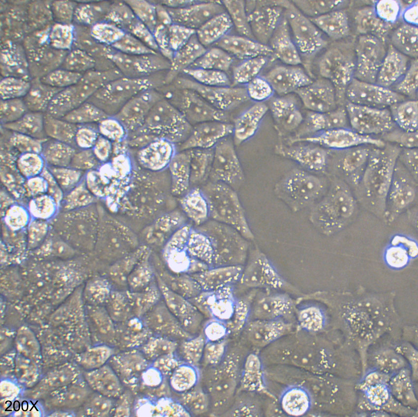 AN3 CA 人子宫内膜腺癌(转移)细胞