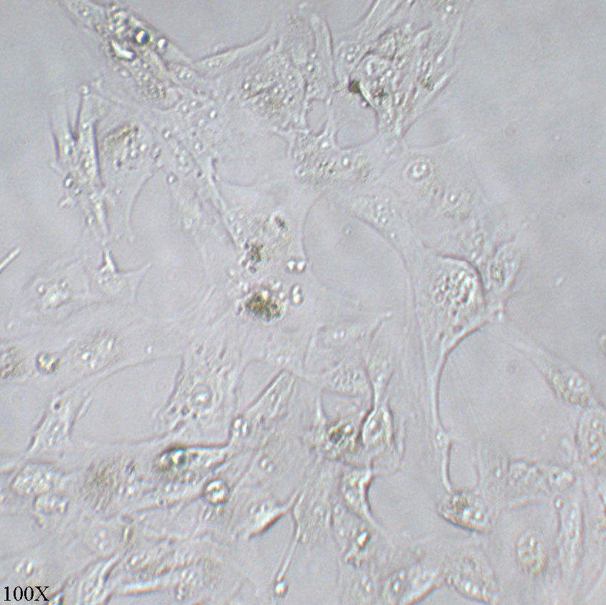 Caki-1 人肾透明细胞癌皮肤转移细胞
